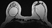 Infiltrating ductal carcinoma, MRI