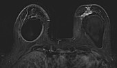 Infiltrating ductal carcinoma, MRI
