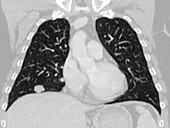 Metastatic lung nodule, CT scan