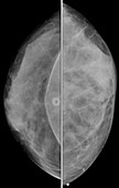 Mammogram of patient with implants