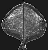 Normal fibroglandular densities, mammogram