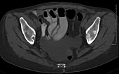 Metastases in hips and pelvis, CT scan