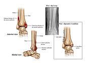 Lateral, Medial and Posterior Malleolar Fracture