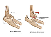 Fractured and Dislocated Elbow, illustration