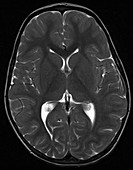 Brain of a 2 year old, normal MRI