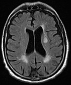 Acute stroke, MRI