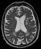 Acute stroke, MRI