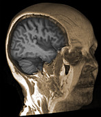 Normal brain, 3D MRI