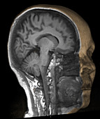 Normal brain, 3D MRI