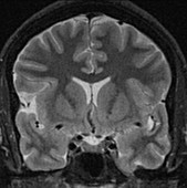 Hypothalamus, MRI