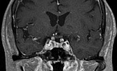 Microadenoma, MRI