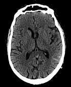 Subarachnoid haemorrhage, CT scan