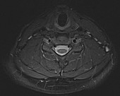 Normal neck and cervical spine, MRI