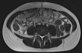 Normal abdomen, lumbar spine, sacrum, MRI