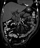 Calcification of mesenteric arteries, CT scan
