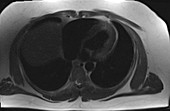 Normal chest and thoracic spine, MRI