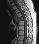 Compression fracture of T7, MRI