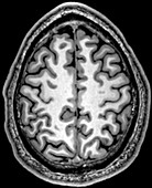 Normal Axial T1 Brain