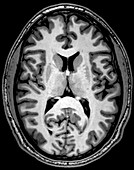 Normal Axial T1 Brain
