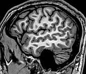 Normal Sagittal T1 MRI Brain 1