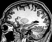 Normal Sagittal T1 MRI Brain 5