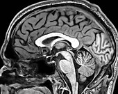 Normal Sagittal T1 MRI Brain 11