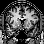 Normal Coronal T1 Brain