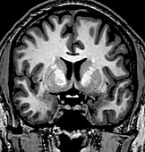 Normal Coronal T1 Brain