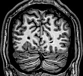 Normal Coronal T1 Brain