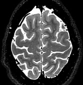 Normal Axial T2 Brain
