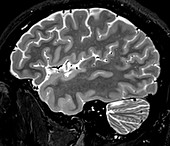 Normal Sagittal T2 Brain 2 0f 11
