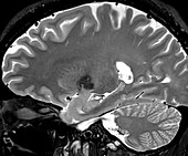 Normal Sagittal T2 Brain 6 0f 11
