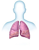Idiopathic Pulmonary Fibrosis, illustration