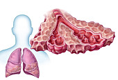Idiopathic Pulmonary Fibrosis, illustration