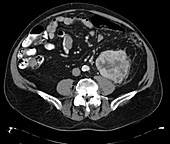Renal carcinoma, CT scan