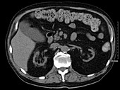 Chronic renal failure, CT scan