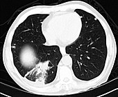 Metastatic renal carcinoma, lungs, CT scan