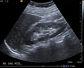 Normal kidney, ultrasound