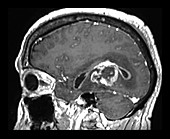 Glioblastoma, MRI