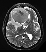 Large Frontal Meningioma, MRI