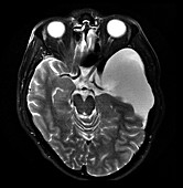 Large Arachnoid Cyst, MRI