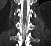 Conus Medullaris on CT Myelogram