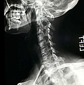 Normal Cervical Spine, X-Ray