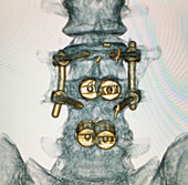 Spinal Instrumentation from 3D CT Scan