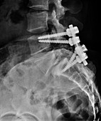 Lumbar Spinal Instrumentation, X-Ray