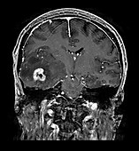 Glioblastoma Temporal Lobe, MRI