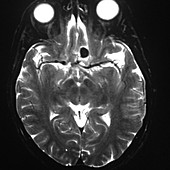 Ophthalmic Segment Aneurysm, MRI