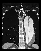 Aortic Dissection, CTA