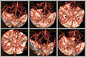 Cerebral atrophy, 3D CT angiogram