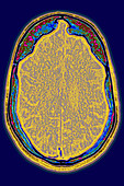 Alzheimer's disease, CT scan